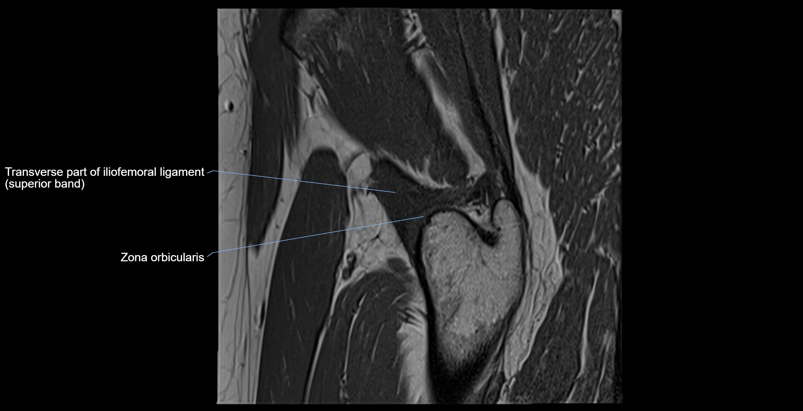 MRI Hip ligaments sagittal cross sectional anatomy 3T  radiology  image-img-00001-00019.webp
